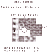 FDT et glaucome