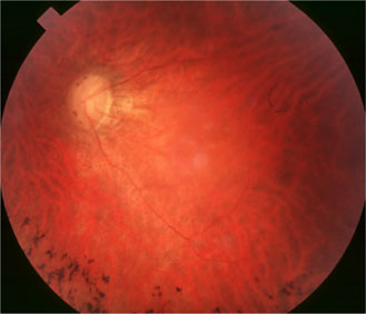 retinopathie pigmentaire
