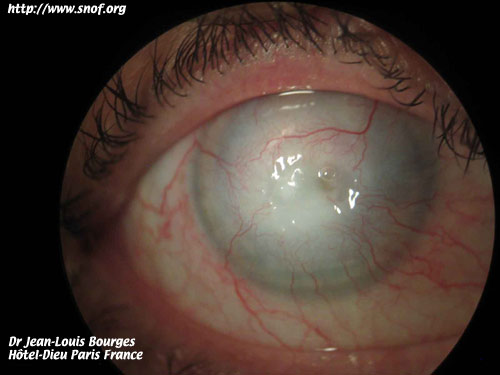 amibes et lentilles cornéennes