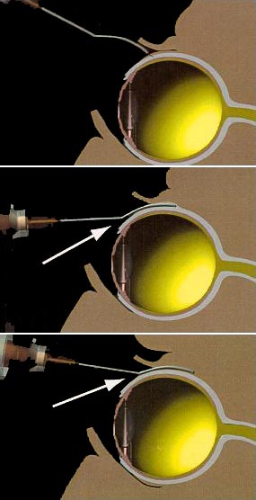 Injection juxta sclérale d'acetate d'anecortave (laboratoire Alcon)