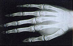 Arachnodactylie