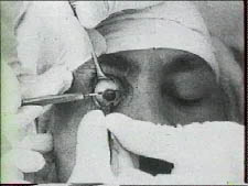 Pr Ignacio Barraquer et opération de cataracte