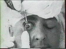 Pr Ignacio Barraquer et opération de cataracte