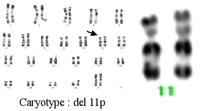 Caryotype avec délétion du chromosome 11