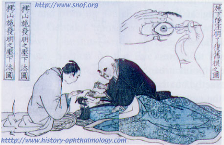 cataract reclination