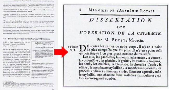 Petit opération de la cataracte le 7 février 1725 