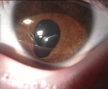 Colobome irien