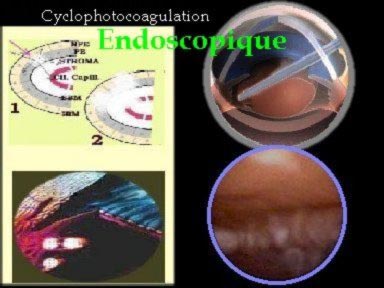 Cyclophotocoagulation