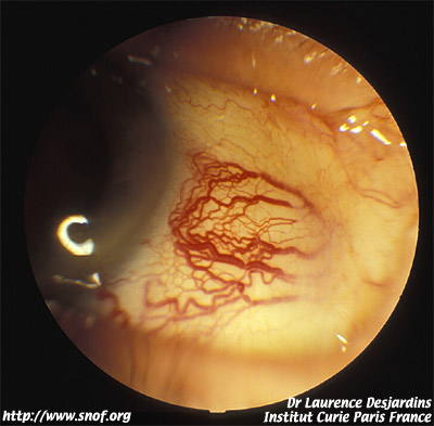 dilatation vaisseaux épiscléraux