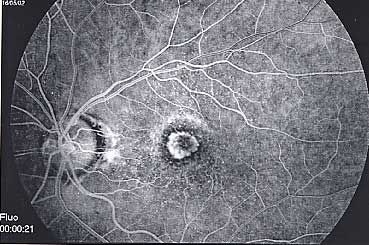 Membrane néovasculaire