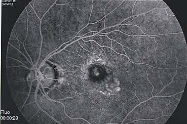 Assèchement de la membrane néovasculaire