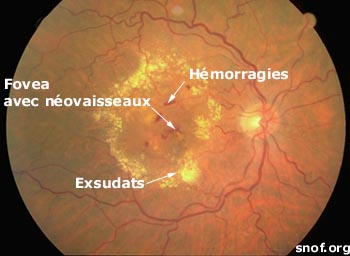 DMLA exsudative avec hémorragies et exsudats