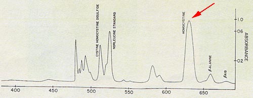 Electrophorèse : Pic d'homocystéine