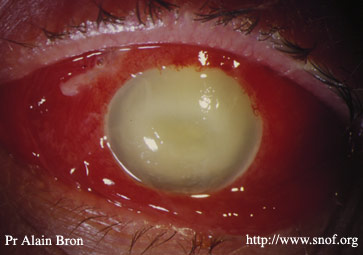 Infection gravissime (endophtalmie)