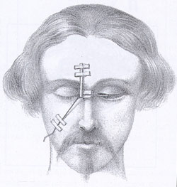Fadenoperation (Illustration Meyer, 1863)