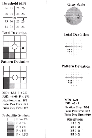 FDT et Humphrey Field Analyser (glaucome)