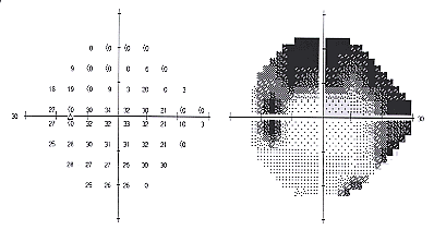 champ visuel automatisé et glaucome