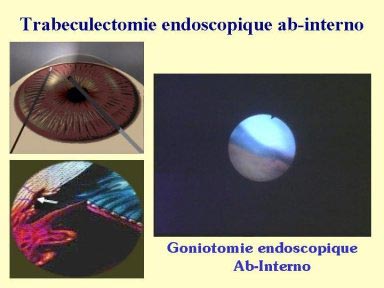 Trabéculectomie endoscopique