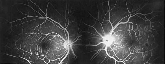 Harada angiography