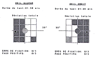 Adénome hypophysaire et hémianopsie