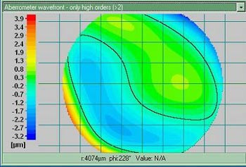 Aberration de haut grade d'un oeil myope