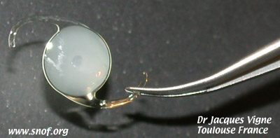 Implant cristallinien devenu opaque