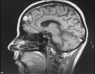 Méningiome frontal droit