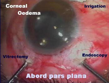 Voies d'abord pars plana