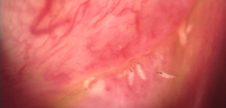 Larves d'oestrus ovis dans le cul de sac conjonctival inférieur