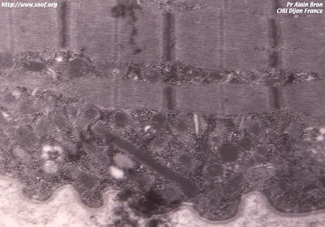 microscopie électronique myopathie