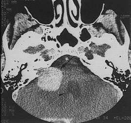 Neurofibromatose de type 2 | SNOF