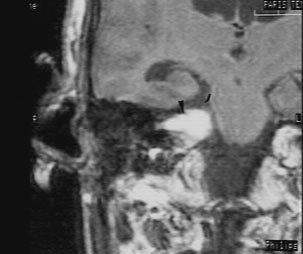 Neurinome de l'acoustique