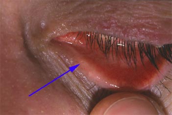 Visualisation du point lacrymal