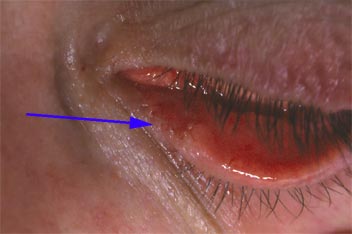 Greffon de conjonctive sur le point lacrymal