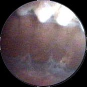 Espace cilio-rétinien ( endoscopie )