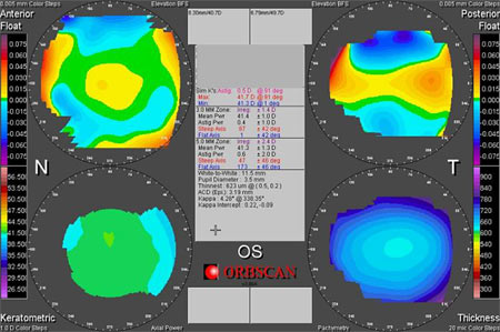 Tracés d'un oeil normal (orbscan)