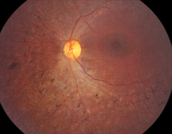 retinitis pigmentosa