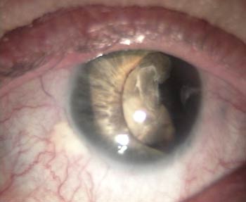 Larmoiement des yeux: 8 causes possibles - IRIS