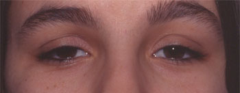 Ptosis congénital bilatéral