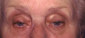 Ptosis involutif bilatéral, lipoptose médiale et dermatochalasis