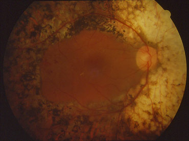 panphotocoagulation rétinienne