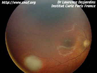 retinoblastoma