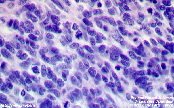 histologie d'un rétinoblastome