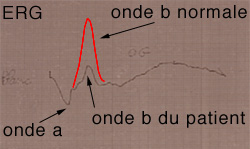 Electrorétinogramme