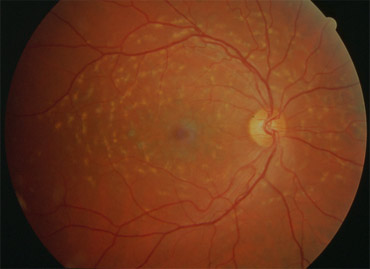 Forme Fundus flavimaculatus de la maladie de Stargardt