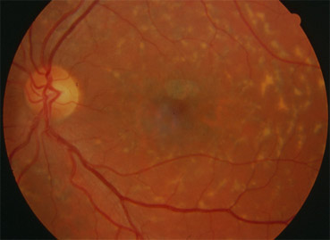 Forme Fundus flavimaculatus de la maladie de Stargardt