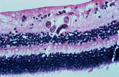 Larve de toxocara canis dans rétine