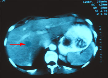 Granulome hépatique de toxocara canis