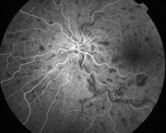 occlusion de la veine centrale