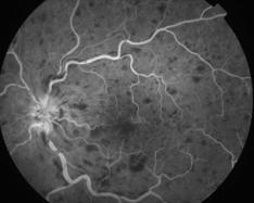 occlusion de la veine centrale